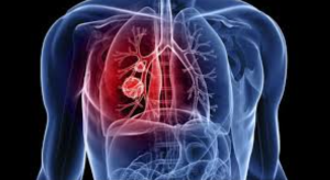 Use of AI to identify tuberculosis patients at Shuklaphanta